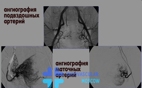 Ангиография маточных и подвздошных артерий