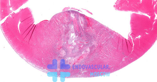 Гистологическая картина некроза миокарда