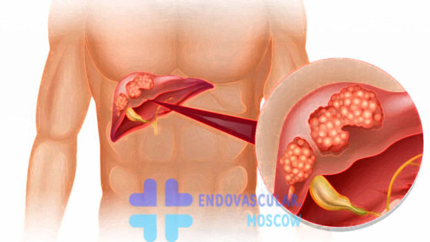 liver-cancer Опухоли печени (злокачественные): ГЦР, ХЦР и метастазы