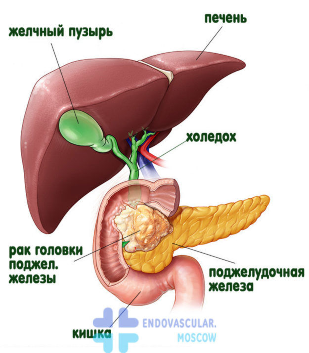 rak-golovki-podjeludochnoi-jelezi Рак головки поджелудочной железы схема
