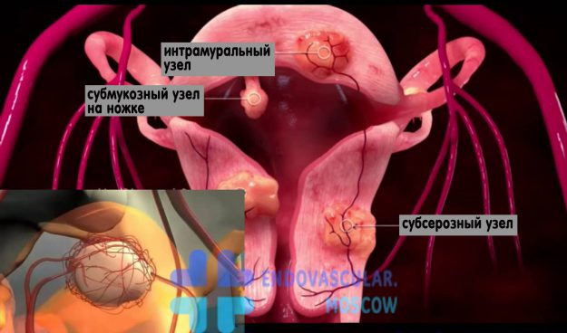 Виды узлов при миоме матки