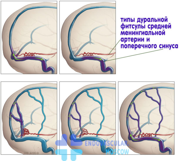 Дуральная артерио-венозная фистула