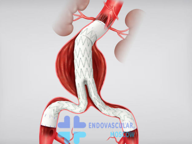 stent-graft-bryushnoi-aorti EVAR