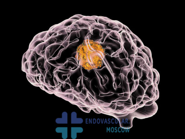 embolizatsiya-avm Эмболизация артери-венозной мальформации