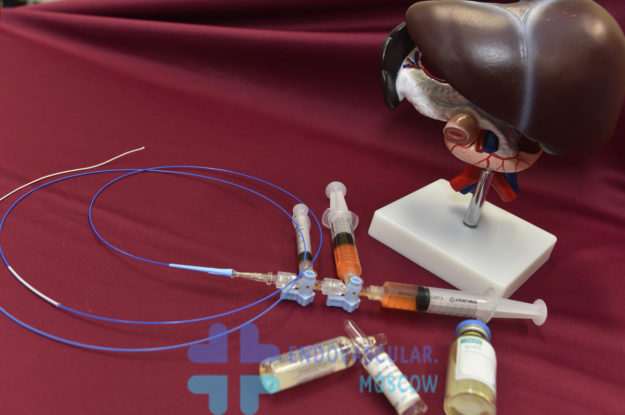 chemoembolization-moskva Химиоэмболизация рака печени в Москве